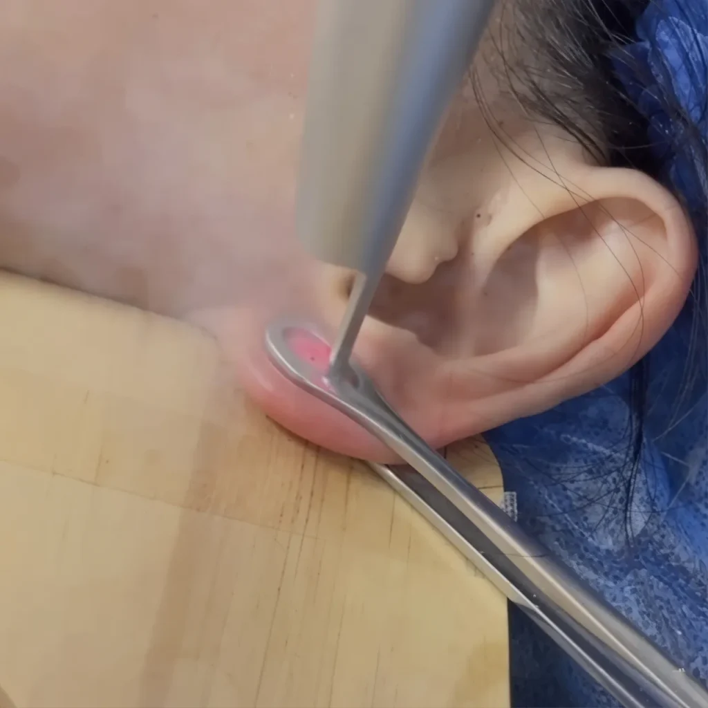 Piercing na Orelha:Piercing a Laser