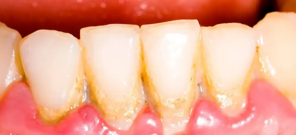 Acúmulo de placa bacteriana nos dentes