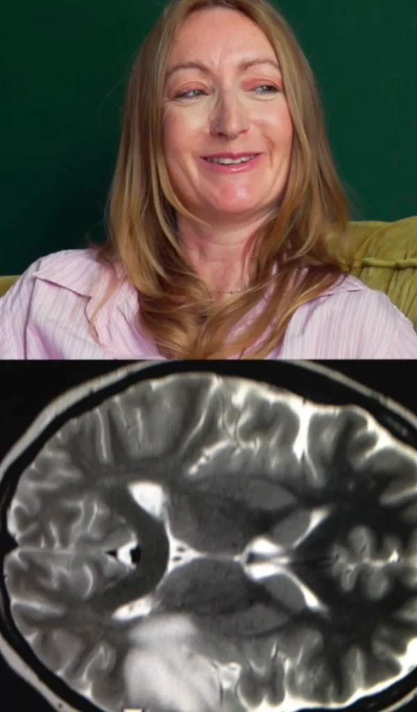 Ressonância magnética mostrando cistos de neurocisticercose no cérebro