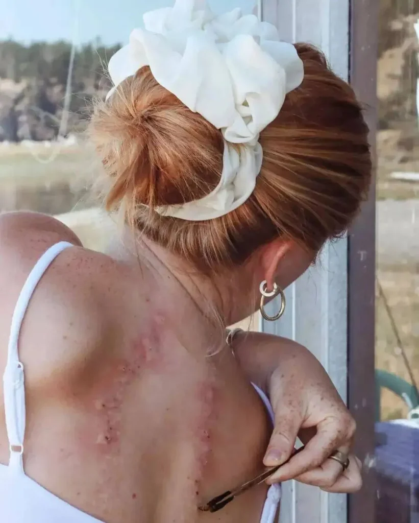 Abelha pousada no braço durante sessão de apiterapia para tratar doença de Lyme